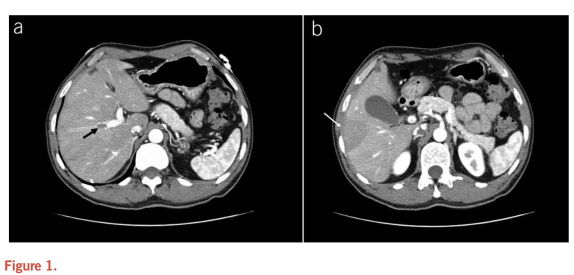 In the NYC COVID-19 epi-center, we stumbled upon an intriguing case of portal vein thrombosis #redjournal #ajg #aheadofprint @aofosu123