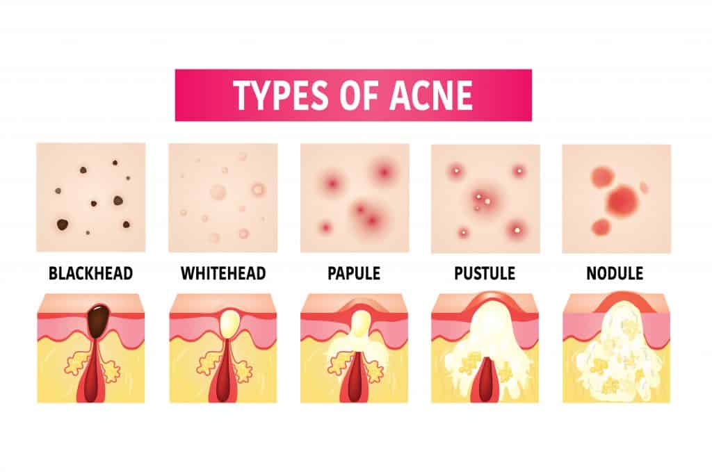 jerawat ada byk jenis tau,umumnya, whitehead & blackhead,Papule-blackhead yg jd radang sbb tak dirawat & dijangkiti bacteriaPustule-bintik merah meradang & tak diubati,bernanah Nodule- jerawat batu,besar, sbb liang pori tersumbat & bakteria masuk lapisan kulit plg bawah