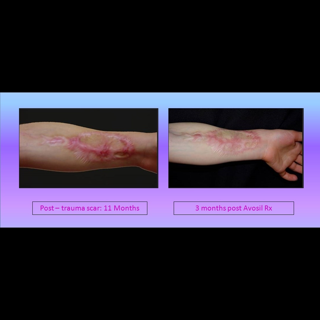 AvocetCorp's tweet photo. Avosil is safe, effective, easy to use, controls inflammation and tenderness. Avosil has known pharmacology, and proper dose and usage. 

Amazon: https://t.co/ww9wjIIqVa. 
#skin #scar #scarring #hypertrophicscar #plasticsurgery #keloidscar #hypertrophicscarring #acnescars #beauty https://t.co/zKzYXGLRz6