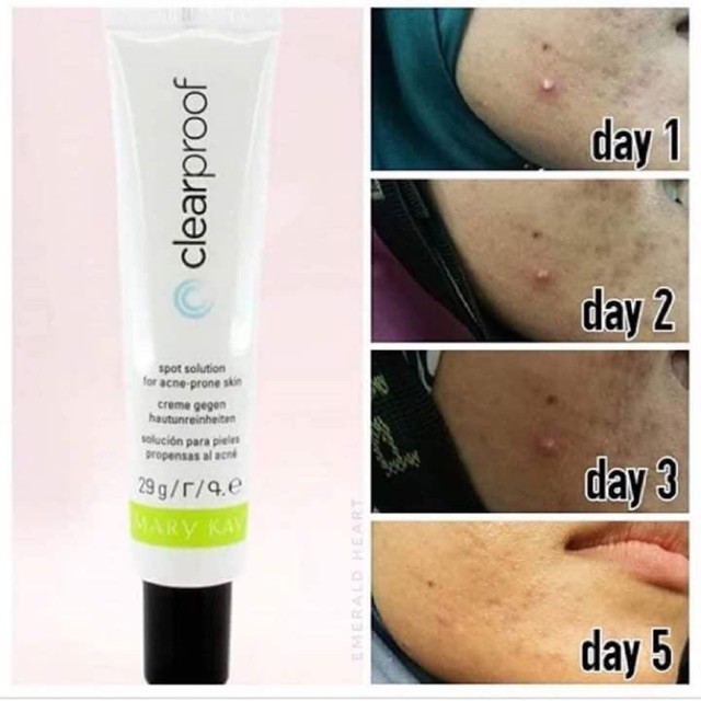 Qai boleh suggest Acne Spot Solution from MaryKaySangat best tauand boleh tahan up to 6 months+Harga sgt affordable and mampu milik tau..If you want to try and know details about it, you can ws me https://wa.link/i1stya&nbsp;