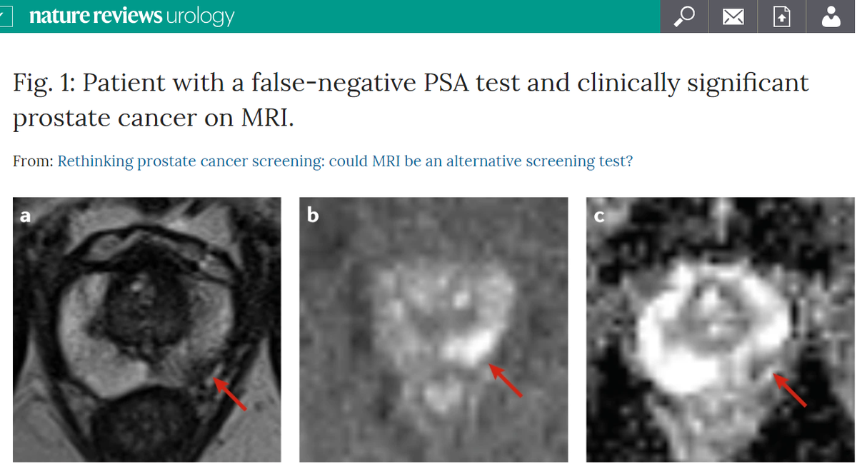 Can MRI be a screening test for prostate cancer? #PROSTAGRAM

Read our new paper here nature.com/articles/s4158…

<a href="/eldredevans/">David Eldred-Evans</a> <a href="/LondonProstate1/">Hashim U. Ahmed</a> <a href="/HemmySokhi/">Dr Heminder Kaur Sokhi</a>  <a href="/ProfPadhani/">Anwar Padhani</a> <a href="/TUF_tweets/">TheUrologyFoundation</a> <a href="/ImperialMed/">Imperial Medicine</a> <a href="/Connor_Urol/">Martin J. Connor</a> <a href="/AtlantaIp2/">IP2 - ATLANTA Trial</a>