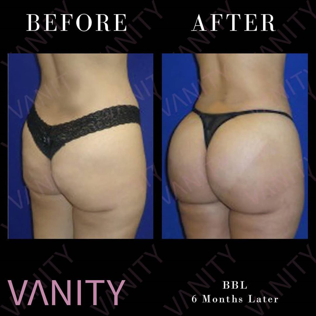 vanityistanbul's tweet photo. One of the most successful body shaping surgeries is BBL!
Brazilian Butt Lift reshapes your body to your desire, you can have tiny waist and big butt with this surgery.
You can ask your questions in the comments down below
#VanityCosmeticSurgery #VanityBBL #BBL #BrazilianButtLift https://t.co/RfLvQOrXkr