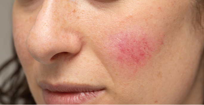 deltalaser's tweet photo. We can help you avoid foods &amp; drinks that trigger your #Rosacea. #Delta https://t.co/Cd21RodTq1 https://t.co/A8oVnBqhbC