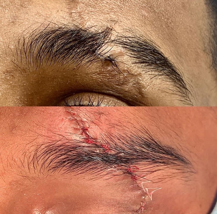 AndeiSoI's tweet photo. Eyebrow Repair Done under Local anesthesia #drsunilrichardson #finework #redosurgery #eyebrwshaping #eyebrowtutorial #eyebrowstransformation #MedTwitter https://t.co/1Y9nOFJjDv