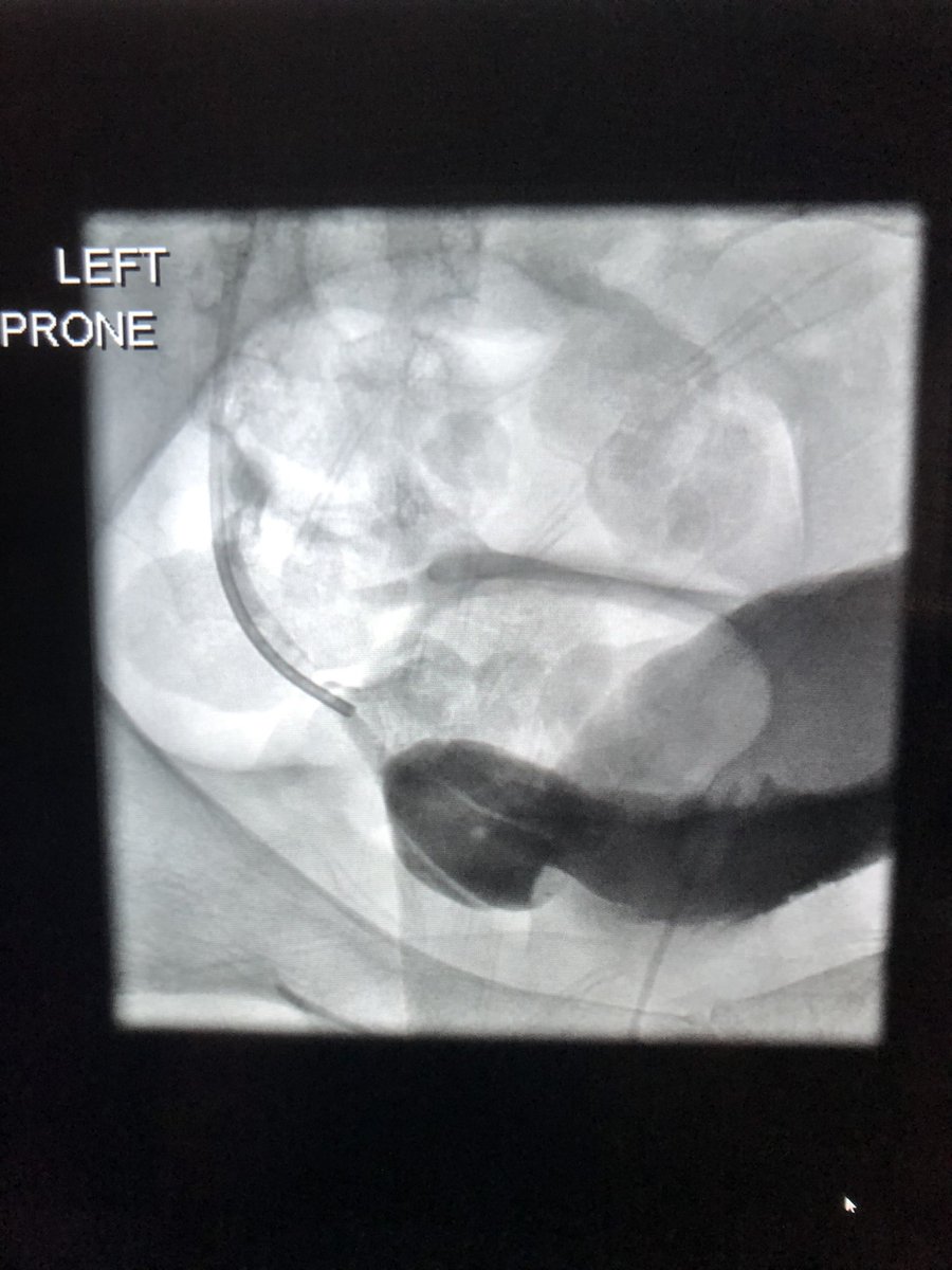 tazzalc's tweet photo. What made this antegrade ureteric stent more difficult to place? It’s a beautiful example of it! #FOAMrad #interventionalradiology #pathognomonic https://t.co/iykhMQva0h