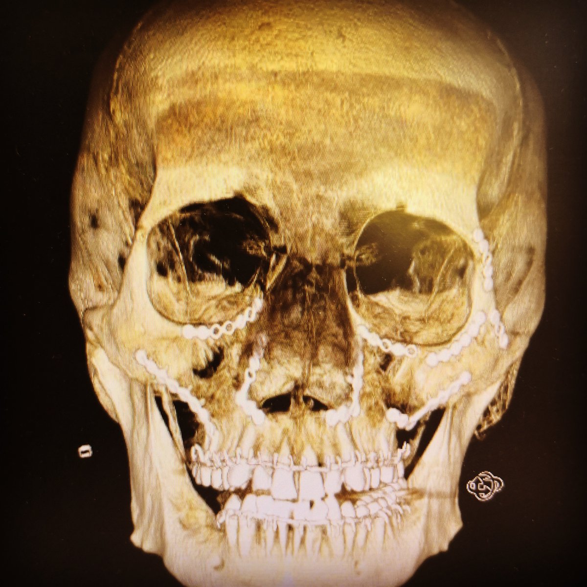 Allez cadeau, cher <a href="/EmmanuelMacron/">Emmanuel Macron</a> , une photo mon crâne en titane après une "incivilité" dans le métro parisien, comme vous dites. Moi, au moins je suis vivant pour témoigner du fait que l'impunité existe quand on agresse en France... Qui se soucie des victimes ?