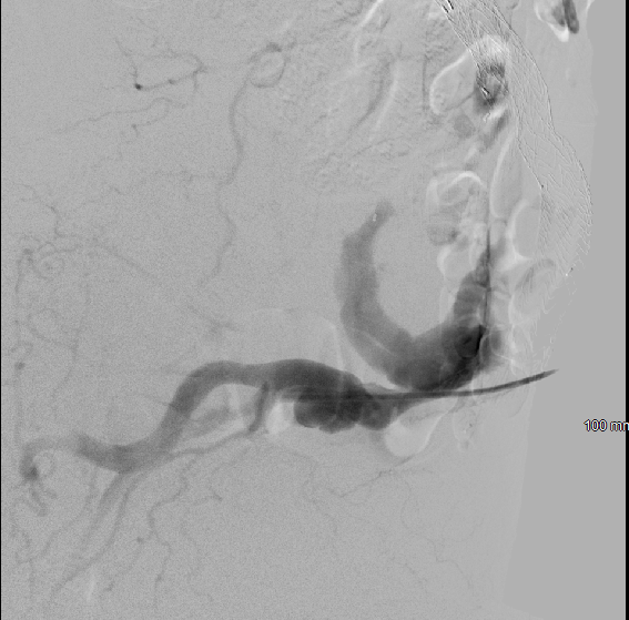 michaeldburns's tweet photo. 10 cm common iliac artery aneurysm. Prior stent graft; enlarging due to inflow from internal iliac. IR for direct sac puncture and 22mm AVP2 plug &amp; coils placed in IIA. 
#IRad #minimallyinvasive #iliac https://t.co/ObSdMyfMWC