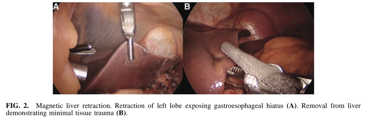 Daniel Guerron MD FACS FASMBS (@danguerron) on Twitter photo Less incisions more 🧲 <a href="/DukeSurgery/">Duke Surgery</a>
Magnetic liver retraction in bariatric surgery is associated with decreased postoperative pain scores, decreased hospital LOS, and increased operating supply costs.pubmed.ncbi.nlm.nih.gov/32678701/ <a href="/SAGES_Updates/">SAGES is in Tampa in 2026!</a> <a href="/SOARD_JOURNAL/">SOARD Journal</a> <a href="/IfsoSecretariat/">IFSO</a> Less incisions more 🧲 <a href="/DukeSurgery/">Duke Surgery</a>
Magnetic liver retraction in bariatric surgery is associated with decreased postoperative pain scores, decreased hospital LOS, and increased operating supply costs.pubmed.ncbi.nlm.nih.gov/32678701/ <a href="/SAGES_Updates/">SAGES is in Tampa in 2026!</a> <a href="/SOARD_JOURNAL/">SOARD Journal</a> <a href="/IfsoSecretariat/">IFSO</a>