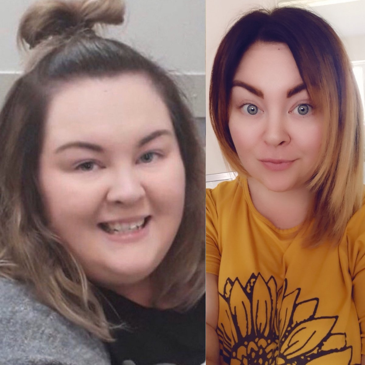 Emily46204124's tweet photo. #transformationtuesday #changingfaces #verticalsleevegastrectomy #vsg #weightlossjourney #weightlosssurgery #wls #wlscommunity #bariactricbabes  #iamabariatricpatient https://t.co/6bpbqUo3SH