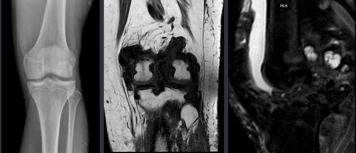 SabanaRadRes's tweet photo. Nuestro primer caso:
Paciente de 32 años sin antecedentes de importancia, consulta por gonalgia y limitación para la marcha.
¡Participa en la encuesta y no dudes en comentar cualquier hallazgo! #RadCases #Radiology #FOAMrad #SabanaRadRes https://t.co/9TwszgPv0K