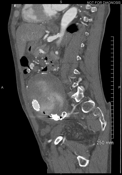 michaeldburns's tweet photo. post procedure CT, note residual contrast in sac from final "sacogram" https://t.co/HexOxCuzEu