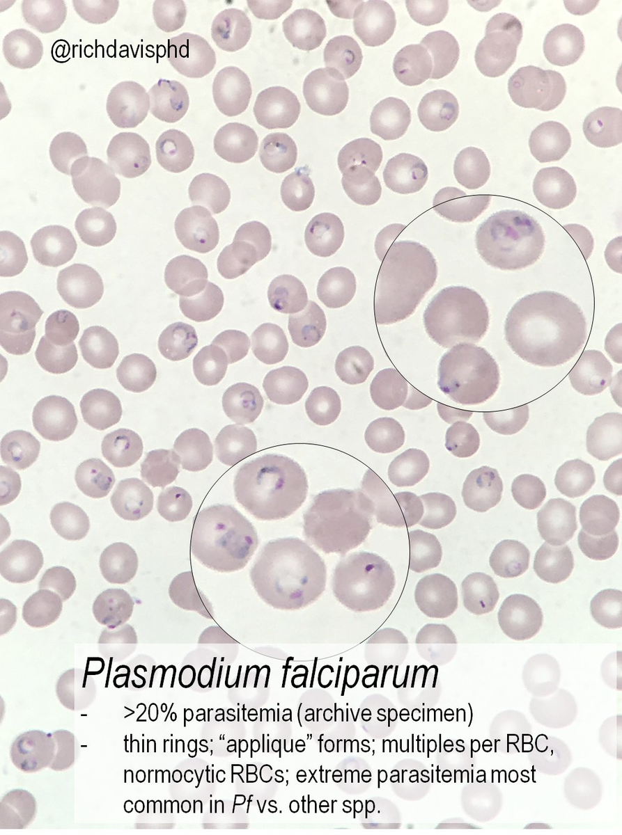 Immune Regulators Predict Severity of Plasmodium vivax Malaria -  Microbiology - mobile.Labmedica.com