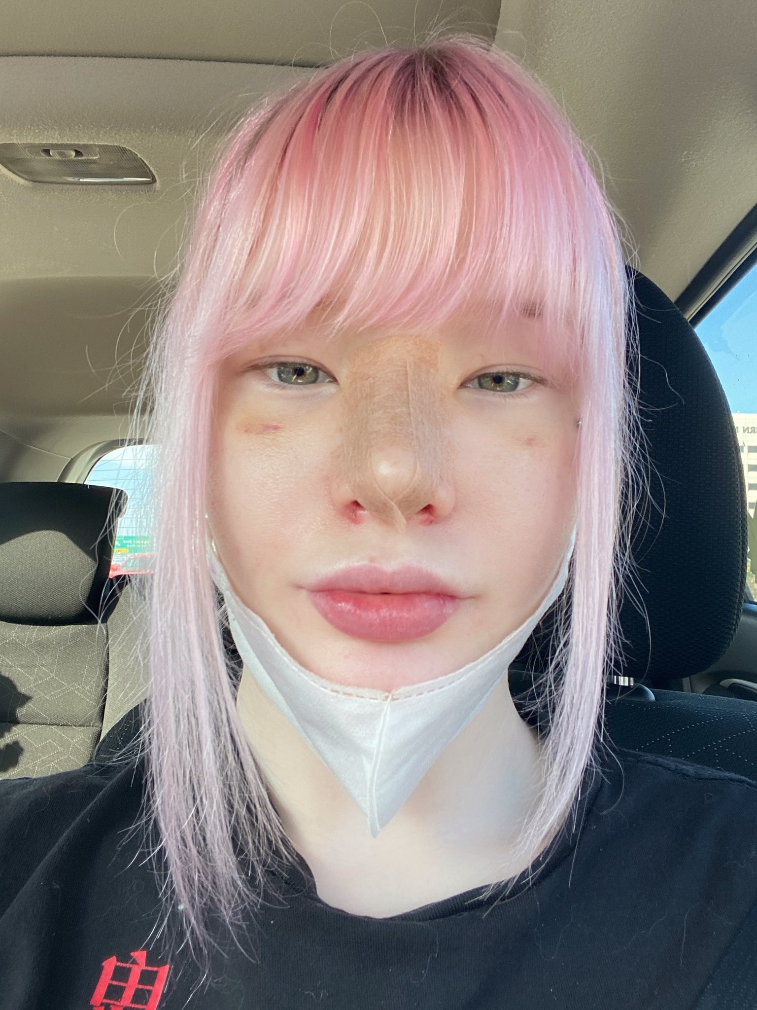lyn on X: swollen nose and tape for the next two weeks!  t.coVRoCpXGZ53  X