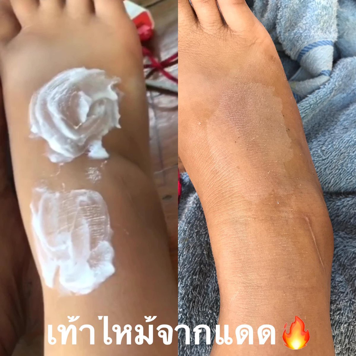 primpink_shop's tweet photo. ขาไหม้ ดำแดด จบปัญหาด้วยเซ็ตพอกโสม 🤟🏻🌈💜 https://t.co/Z0zFojzFTc