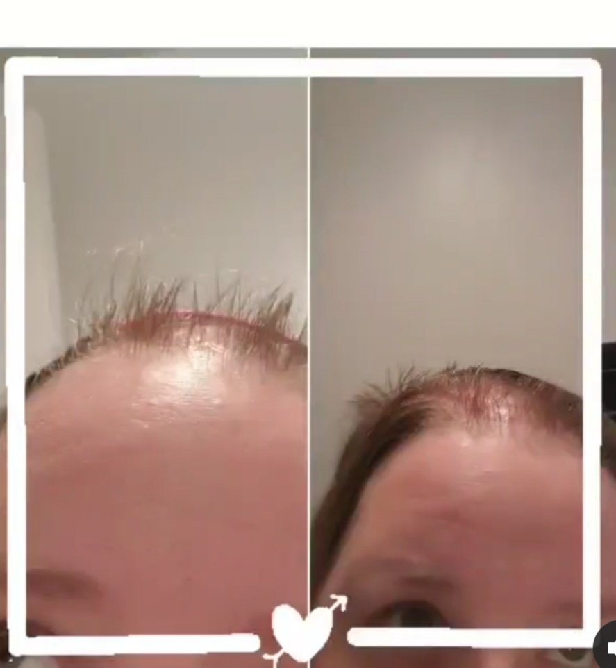 SeeJanie_tweet's tweet photo. The little hair that could.
2.5 months of growth standing at attention.
#lifeafterbrainsurgery
#meningioma https://t.co/5GREjpOdnd