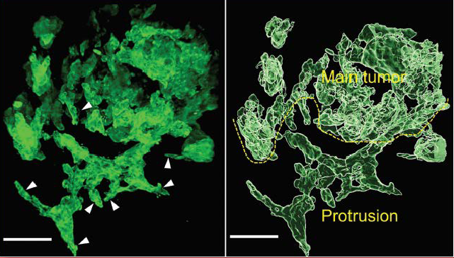 OshimaKiyoko's tweet photo. Our 3-dimmensional analysis image of extrahepatic cholangiocarcinoma study was selected for the cover of August issue of the Journal of Pathology. https://t.co/tSeiFtuQPk https://t.co/61AD4V7ciZ