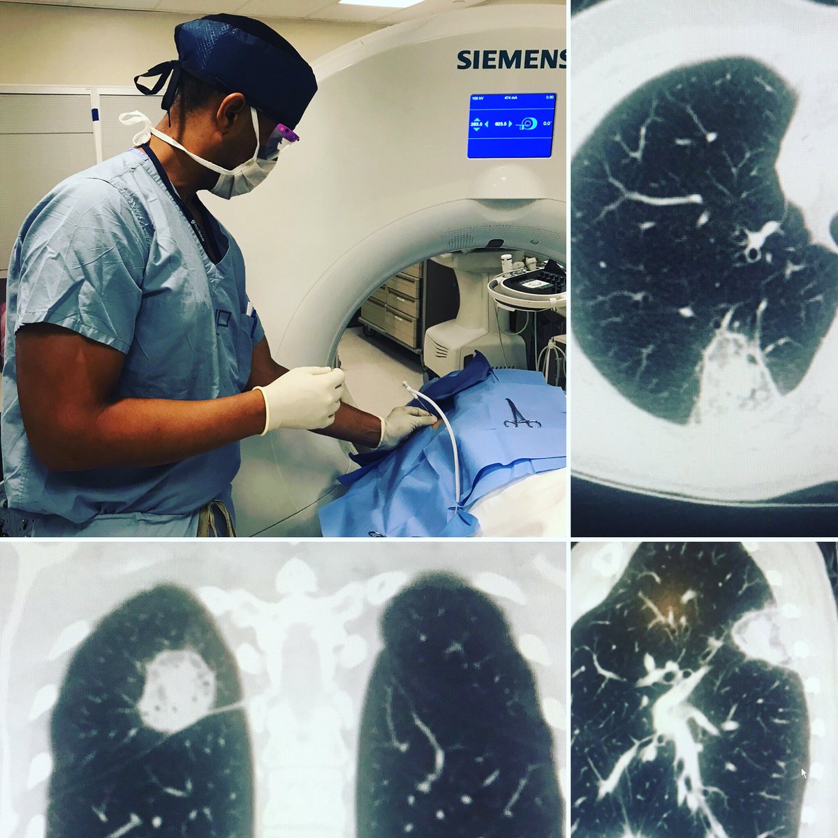 md_rogue's tweet photo. @DoubledocJB @PigiLab placing a cryo needle into a tumor in the lung. It’s satisfying to see that bulls-eye “target halo” sign on the one month followup chest CT after #lungablation so the aim was spot on. #fcancer #lungcancer #targetsign #halosign @pennmedicine @Penn_IR https://t.co/kG4bBpIuQQ