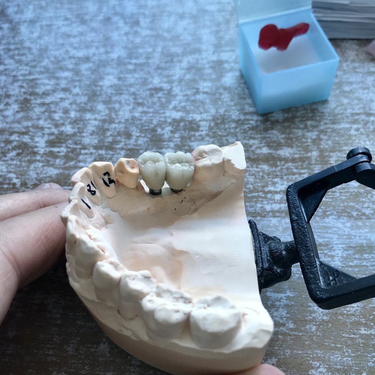 FullService_CDL's tweet photo. Many Implant works finished every day.

Waiting for your inquiry.

Email: mr.doczhang@gmail.com

whatsapp: +86 18823711832 https://t.co/z42IQOBnoI