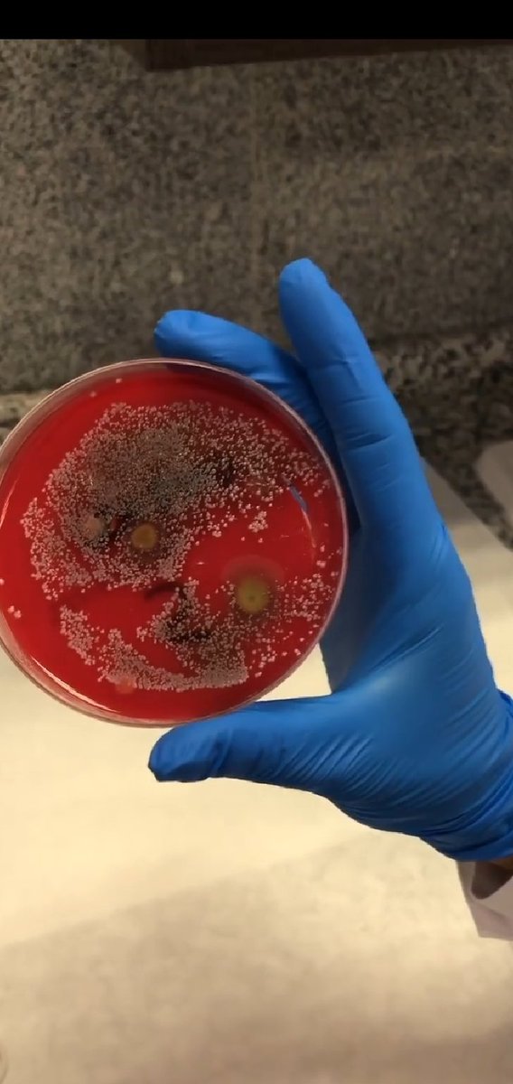 #Mascarillas y #Bacterias  Resultado de un uso intensivo de una mascarilla durante varias semanas. ►#marisagalonso

vídeo :[🎬instagram.com/tv/CCwb0ZfqMjS… ]