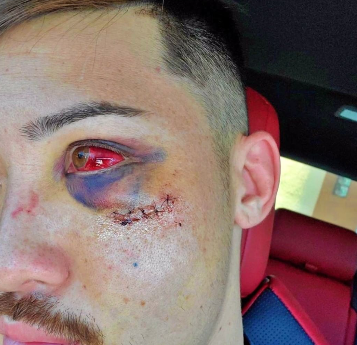 emmettglenn's tweet photo. Young @bostonboomboom (Boston Salmon) showing the damage done to his eye by Shawn West on the #LFA84 card, July 10th.
Boston to suffer a broken orbital and cheekbone due to knee.
Although he got the win do we think West should be punished more by the Commission?
#MMATwitter https://t.co/fs8tMkgCsw