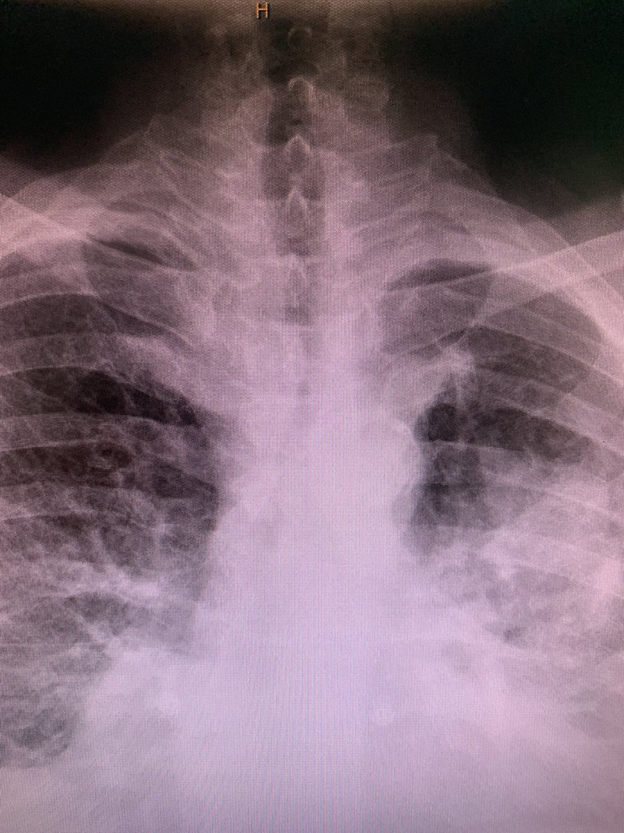 AnestHVH's tweet photo. Saber-sheath Trachea. Laryngeal mask ventilation because of air leaking during endotracheal intubation @vallhebron @anest_vhebron @NeumologiaHVH @MCobretti @ToneteTonino https://t.co/M8X2fylYj9
