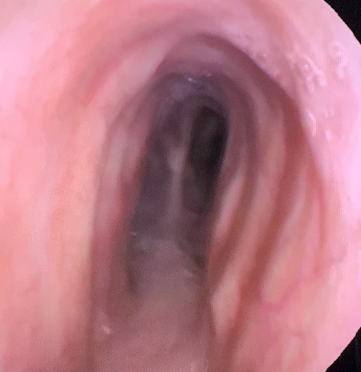 AnestHVH's tweet photo. Saber-sheath Trachea. Laryngeal mask ventilation because of air leaking during endotracheal intubation @vallhebron @anest_vhebron @NeumologiaHVH @MCobretti @ToneteTonino https://t.co/M8X2fylYj9