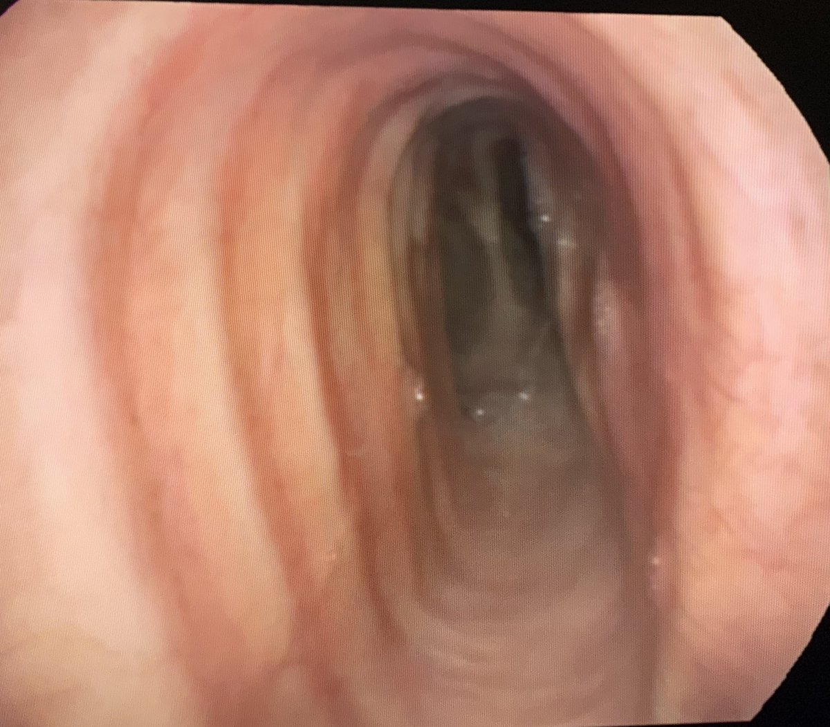 AnestHVH's tweet photo. Saber-sheath Trachea. Laryngeal mask ventilation because of air leaking during endotracheal intubation @vallhebron @anest_vhebron @NeumologiaHVH @MCobretti @ToneteTonino https://t.co/M8X2fylYj9