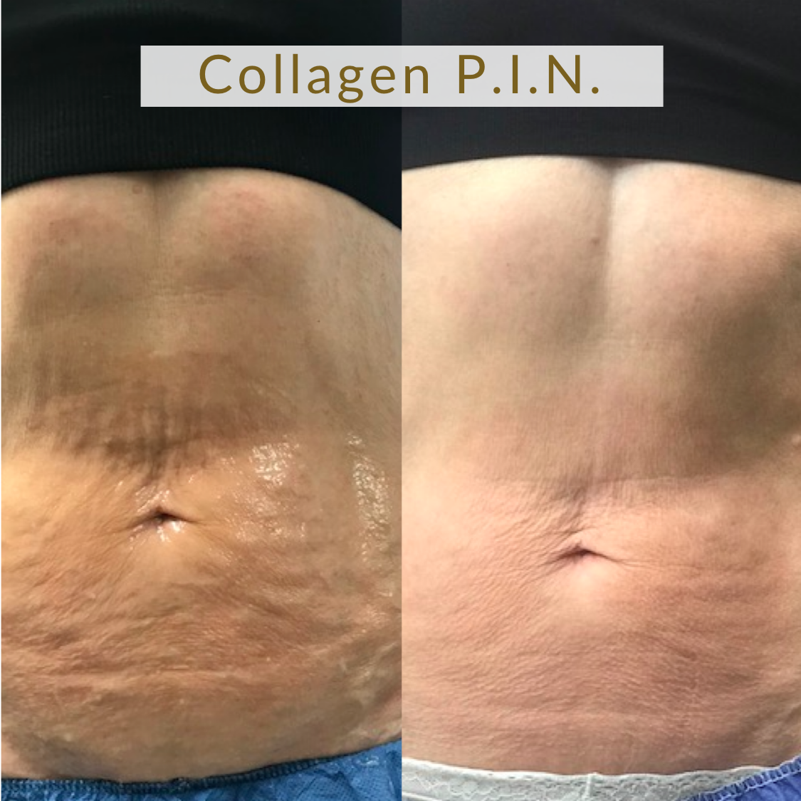 ✨Tighten the Sagging, Crepey Lower Belly ✨ Collagen P.I.N. targets lower wrinkly belly skin caused from excessive weight loss, aging, lack of moisture, post pregnancy, decline of estrogen/testosterone, or sun damage.