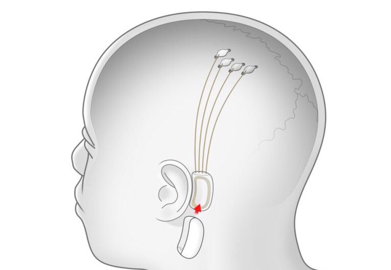 Kulturlesite_'s tweet photo. Elon Musk développe actuellement le projet Neuralink.

Il permettra de streamer de la musique dans son cerveau (sans écouteurs) en faisant vibrer la boite crânienne pour créer un son inaudible de l’extérieur.

Le fondateur donnera plus d’infos le 28 août. https://t.co/A7OhEamUNR