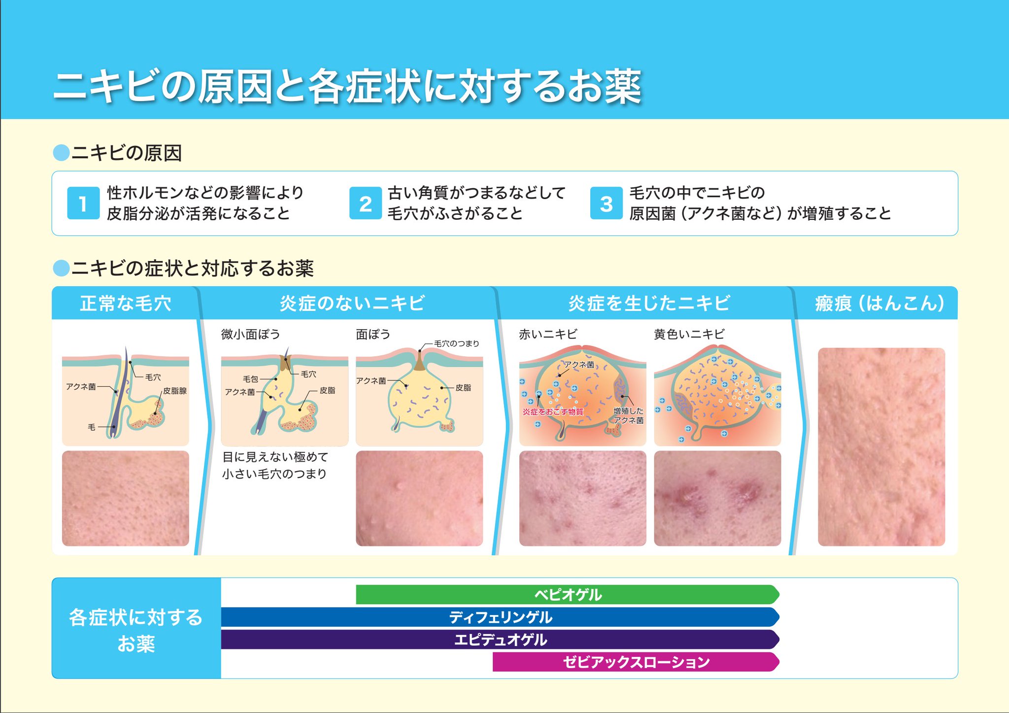 やさしい皮膚科医 Twitter પર ニキビ薬はずっと使える ニキビ薬の主役はピーリング作用で毛穴汚れを取る薬 エピデュオ ディフェリン ベピオいずれも1年間の継続使用データ有り 副作用は開始直後で出る刺激感が多く 徐々に減少 長期使用による問題は