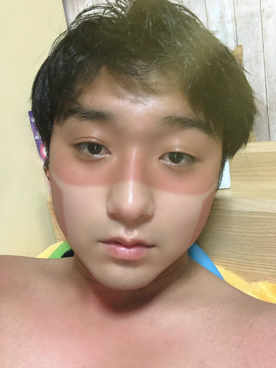 夏にマスクを付けて外出した結果？マスクの形に日焼け跡が残るwww