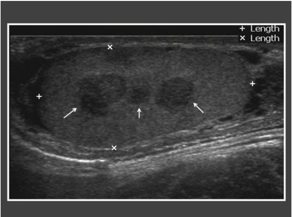 #TART
A 12-year-old boy, was a diagnosed case of CAH on the lower doses of steroid and irregular treatment, develops multiple hypoechoic lesions within the testis (arrows) representing testicular adrenal rest tumour(TART).
Appropriate steroid dosing can prevent this complication.