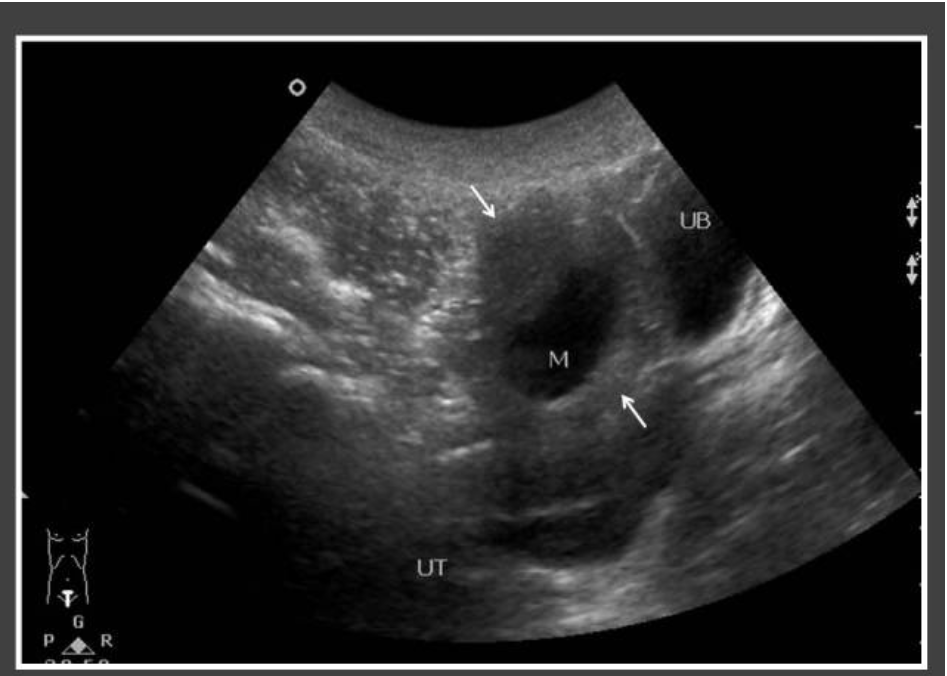 #precociouspuberty
Granulosa thecal cell tumour.(E2 producing tumour)
4 years old female presented with per-vaginal bleeding.
The pelvic ultrasound showed ovarian cysts with the thickened wall. Laparoscopic of the cyst showed granulosa thecal cell tumour in histology.