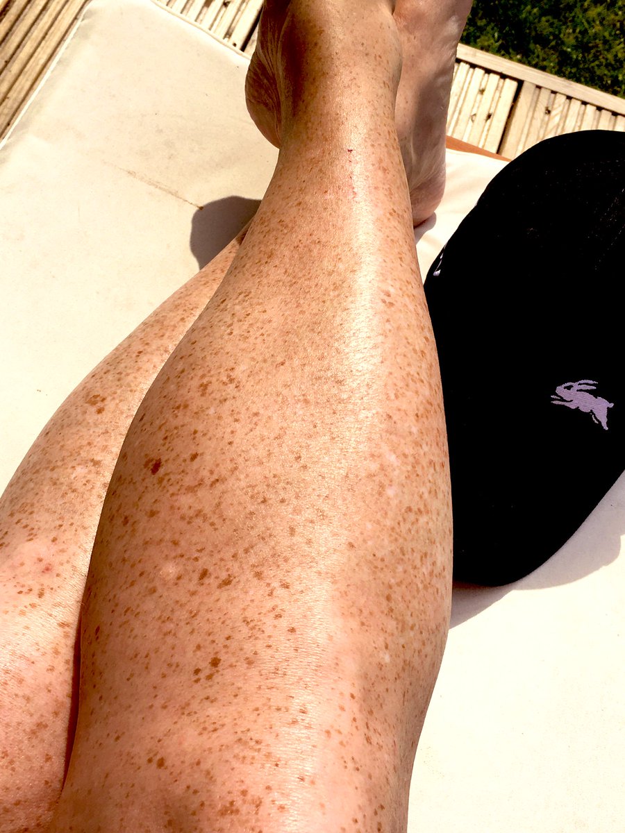 dianamahon's tweet photo. A hat is essential ....ππ»π #scorching #frecklesout https://t.co/WrpyQdD0Mb