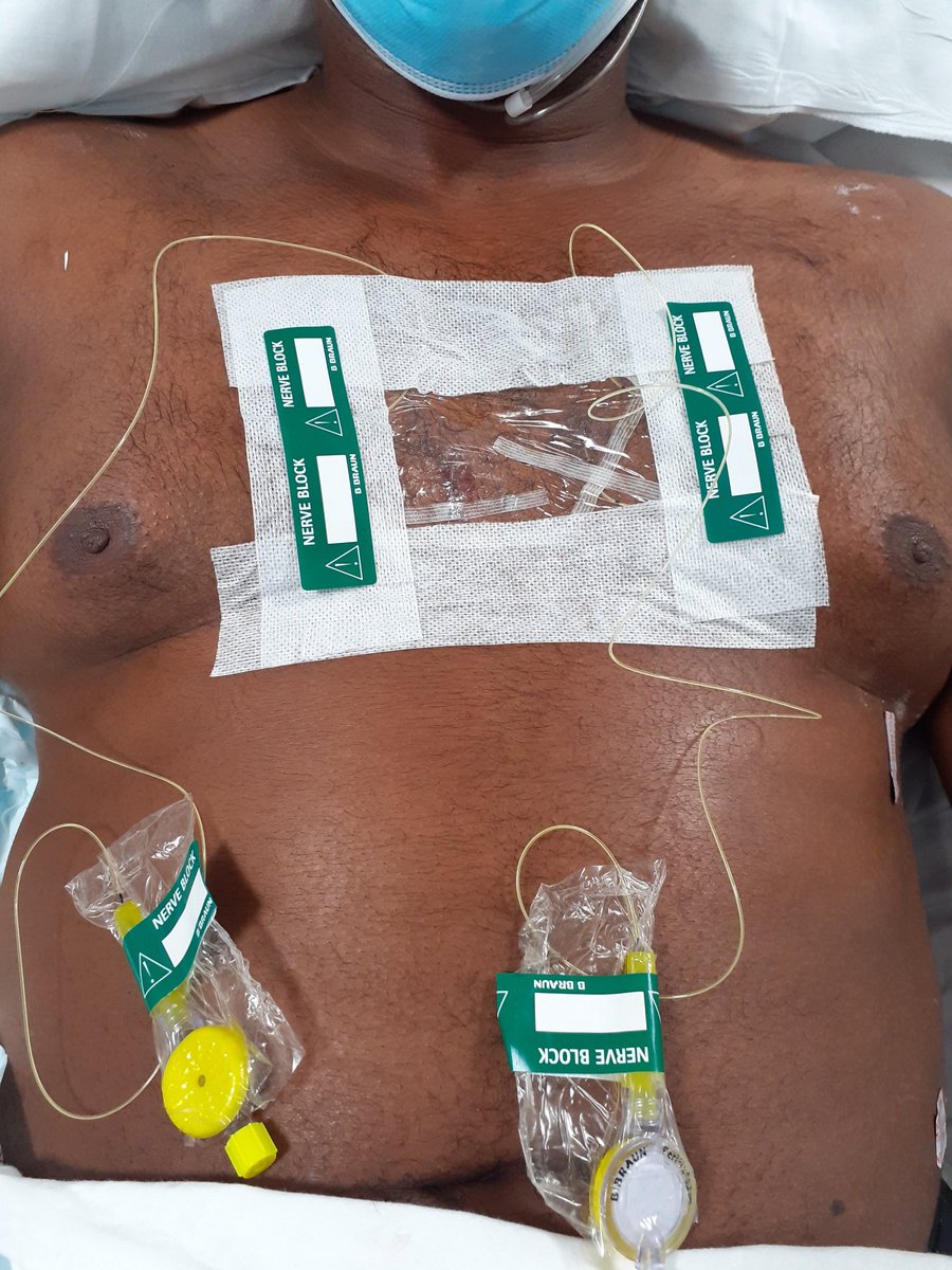 boynebellew's tweet photo. Sterno-manubrial#, ant.rib#, can't deep breathe/cough, sats 88%. Placed bilateral sub-pectoral fascial plane catheters, can deep breathe, ambulate, Sats >95% & pt really pleased. @ImperialNHS RA fellowship alive & kicking 😎 @ESRA_Society approved @RegionalAnaesUK (pt consented) https://t.co/9zqzZDSXPf
