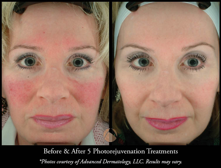 advdermatology's tweet photo. Summertime can be a tough time for those who have rosacea. Check out an article written by Emily Oehler, PA-C and read what you can do to reduce your rosacea during the hot summer months: https://t.co/RNPyvK5qUR

#chicagodermatology #northshorederm #northshoredermatology https://t.co/CmWx2PMUp7