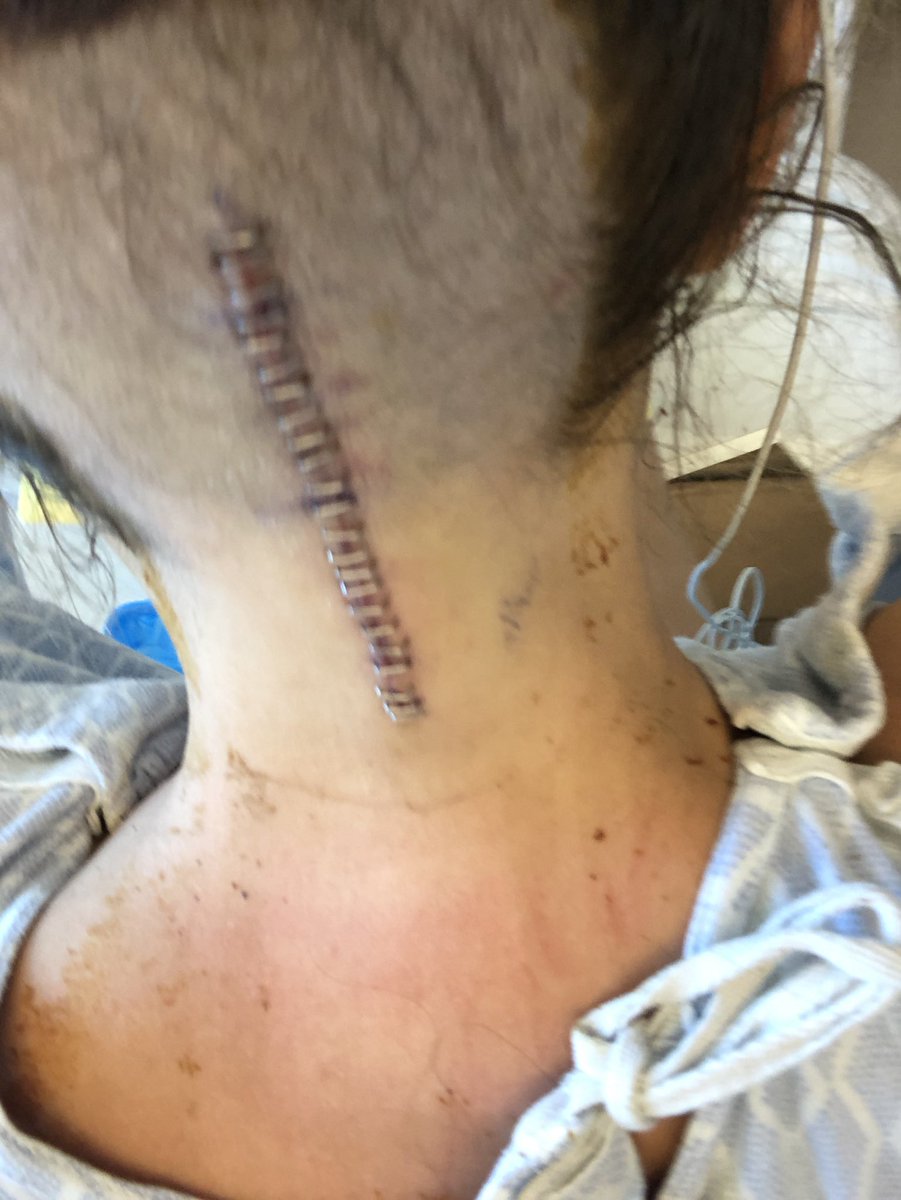 D_lightful_D's tweet photo. Day 2 of recovery from Decompression brain surgery. Feeling better to and a good chance I get to go home today. #ChiariMalformation #chronicillness #ChronicPain #DecompressionSurgery #BattleWounds https://t.co/VRlhfNXw6O