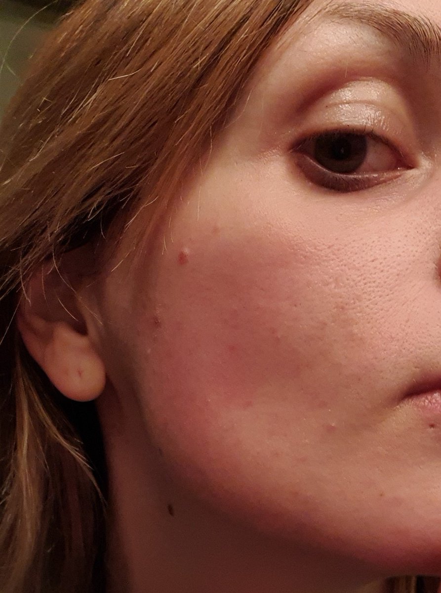 bessbbe's tweet photo. My most favourite thing about the whole day has to be the bat that flew full pelt in to my face, leaving a whopping bat shaped red donk on my cheek. π
July is almost at an end and I cant believe how far we've come π€©π
#Samarathon #BessieGoes #BatFace https://t.co/792DbHOdiO