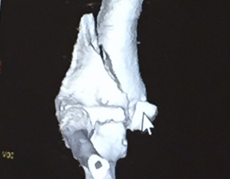 5 years ago on this day would change my life forever! Throwing a baseball was something I’ve done since I was 5 years old, all of that would be taken away on one pitch, in the blink of an eye. Today would be the first day of the most grueling, heart wrenching, mind breaking