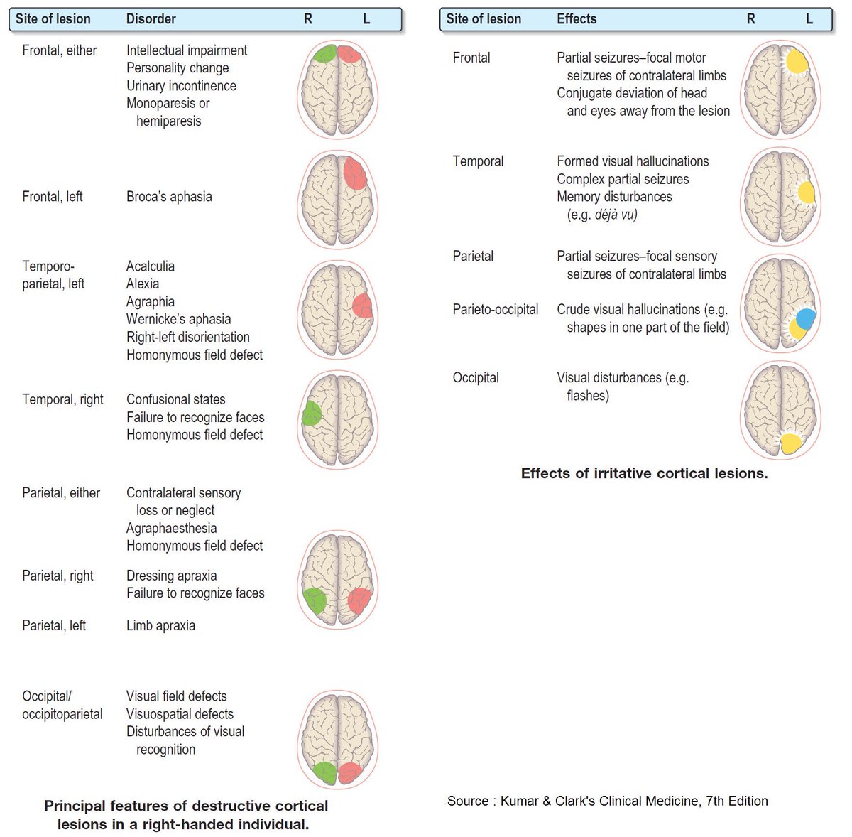 Giana Dawod, MD (@gdawod1) on Twitter photo A brief, visual aid in basic localization of destructive vs. irritative cortical lesions that I distributed to my team at table rounds this morning - hope others find it helpful! <a href="/Tracey1milligan/">Tracey Milligan, MD, MS, FAAN, FANA, FAES</a> #MedTwitter #NeuroTwitter A brief, visual aid in basic localization of destructive vs. irritative cortical lesions that I distributed to my team at table rounds this morning - hope others find it helpful! <a href="/Tracey1milligan/">Tracey Milligan, MD, MS, FAAN, FANA, FAES</a> #MedTwitter #NeuroTwitter