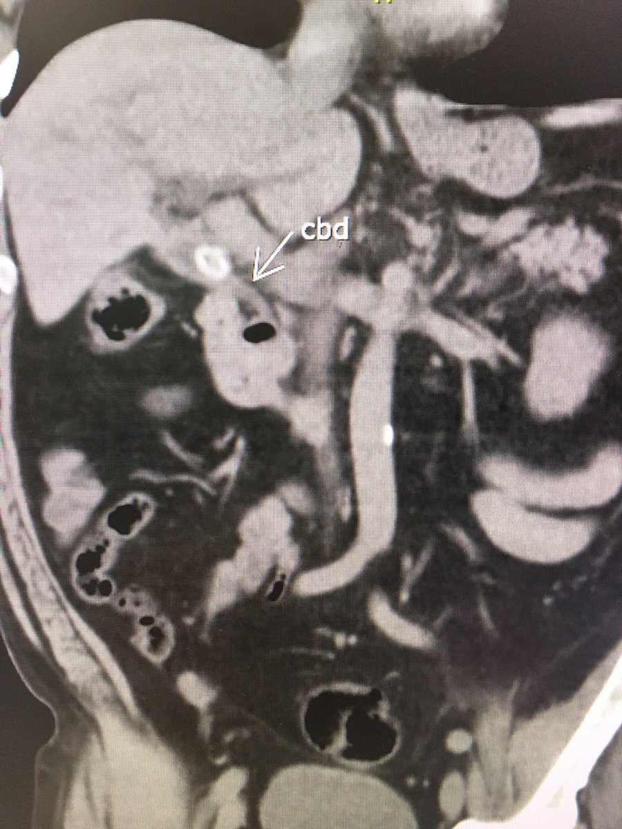 ChahalPrabhleen's tweet photo. An e.g. of utility reviewing images before ERCP. Pt ref for hilar CCA ,brushing -ve, ⬆️bili post ERCP stent, ref for cholangioscooy. Diagnosis ? Why is bili increasing despite stent? @BilalMohammadMD @SanchezLunaMD @theLuthra @KellyHathornMD @jimmyli https://t.co/HkBxILhOKz