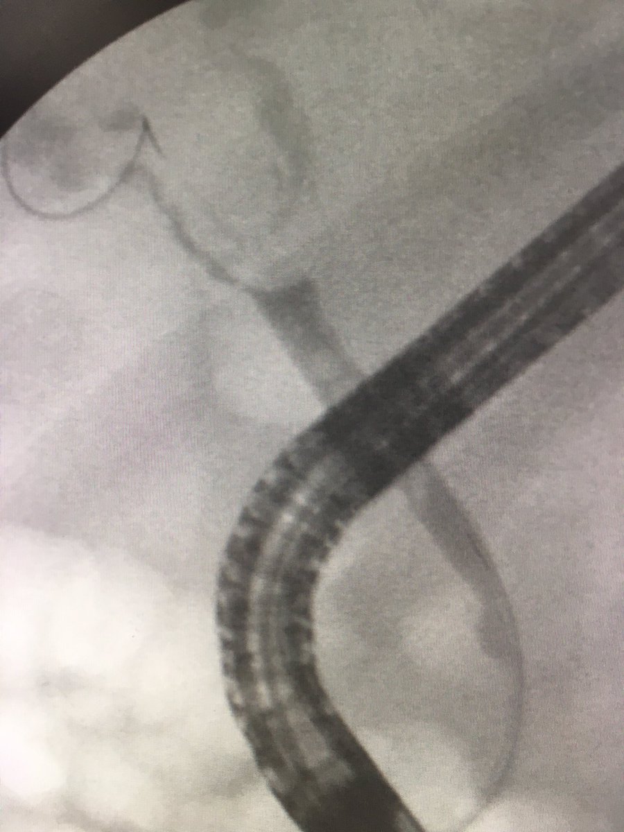 ChahalPrabhleen's tweet photo. An e.g. of utility reviewing images before ERCP. Pt ref for hilar CCA ,brushing -ve, ⬆️bili post ERCP stent, ref for cholangioscooy. Diagnosis ? Why is bili increasing despite stent? @BilalMohammadMD @SanchezLunaMD @theLuthra @KellyHathornMD @jimmyli https://t.co/HkBxILhOKz