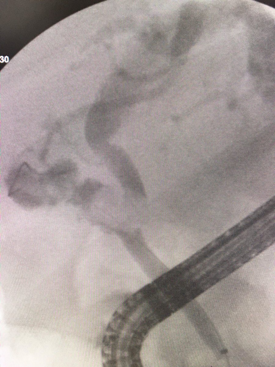 ChahalPrabhleen's tweet photo. An e.g. of utility reviewing images before ERCP. Pt ref for hilar CCA ,brushing -ve, ⬆️bili post ERCP stent, ref for cholangioscooy. Diagnosis ? Why is bili increasing despite stent? @BilalMohammadMD @SanchezLunaMD @theLuthra @KellyHathornMD @jimmyli https://t.co/HkBxILhOKz