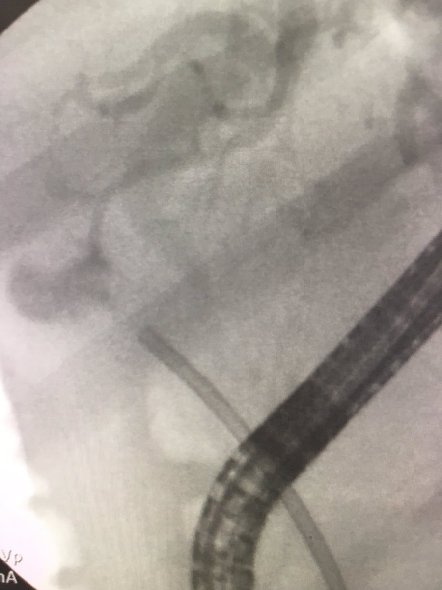 ChahalPrabhleen's tweet photo. An e.g. of utility reviewing images before ERCP. Pt ref for hilar CCA ,brushing -ve, ⬆️bili post ERCP stent, ref for cholangioscooy. Diagnosis ? Why is bili increasing despite stent? @BilalMohammadMD @SanchezLunaMD @theLuthra @KellyHathornMD @jimmyli https://t.co/HkBxILhOKz