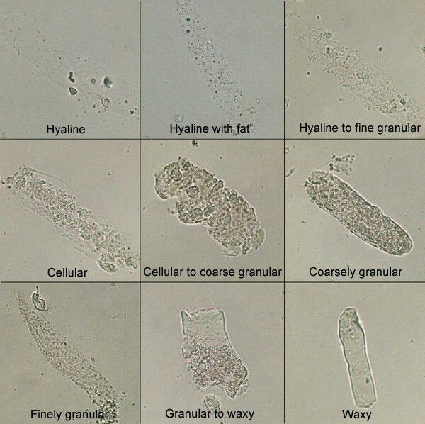 Koutherfaris's tweet photo. انواع ال casts الي ممكن نشوفها في الفحص المايكروسكوبي لعينات البول 🔬 https://t.co/Ko4dmvaomG