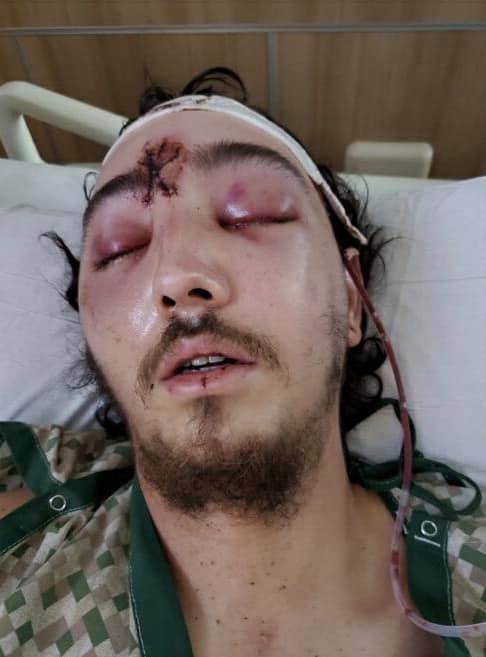 #PortlandProtests #BlackLivesMatter #PortlandKidnappings #PortlandOregon Tommy Sunshine, shot in face in Portland, went through reconstructive surgery, may lose eye, was protesting peacefully when shot by govt. troopers.