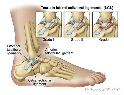 Ankle sprains are one of the most common injuries in sports (Beynnon et. al, 2014).The mechanicsm varies but two thirds of them involve the Calcaneofibular & Anterior Talofibular ligaments (Kaikkonon et. al, 1997).Why people are so prone to chronic ankle instability is not
