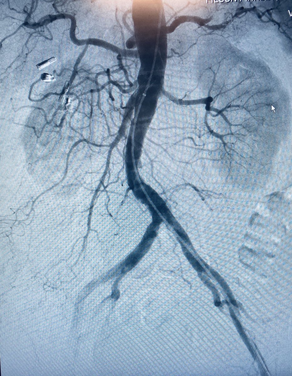 Carlos Guevara MD, FSIR (@carlosguevarair) on Twitter photo Chronic mesenteric ischemia, revascularized from femoral approach (Barbeau D). Combination of V18, Mik 014Glideadv. @Saukalaka <a href="/ZagumBhatti/">Zagum Bhatti MD</a> <a href="/WashUIR/">Mallinckrodt IR</a> <a href="/SDhandMD/">Sabeen Dhand</a> <a href="/JVIRmedia/">JVIR</a> <a href="/LessneVIR/">Mark Lessne, MD</a> <a href="/t_intheleadcoat/">Venkat Tummala MD</a> <a href="/ChrisDMaloneVIR/">Chris Malone</a> <a href="/roblookstein/">Robert A Lookstein MD, MHCDL</a> <a href="/SIRspecialists/">Society of Interventional Radiology</a> <a href="/VISLAMDSCAIP/">GVATAKEN</a> <a href="/LorenzoPatrone3/">Lorenzo Patrone</a> Chronic mesenteric ischemia, revascularized from femoral approach (Barbeau D). Combination of V18, Mik 014Glideadv. @Saukalaka <a href="/ZagumBhatti/">Zagum Bhatti MD</a> <a href="/WashUIR/">Mallinckrodt IR</a> <a href="/SDhandMD/">Sabeen Dhand</a> <a href="/JVIRmedia/">JVIR</a> <a href="/LessneVIR/">Mark Lessne, MD</a> <a href="/t_intheleadcoat/">Venkat Tummala MD</a> <a href="/ChrisDMaloneVIR/">Chris Malone</a> <a href="/roblookstein/">Robert A Lookstein MD, MHCDL</a> <a href="/SIRspecialists/">Society of Interventional Radiology</a> <a href="/VISLAMDSCAIP/">GVATAKEN</a> <a href="/LorenzoPatrone3/">Lorenzo Patrone</a>