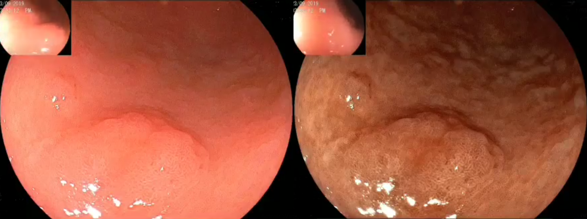 👉Presentamos el siguiente caso: Lesión de 12 mm en antro proximal curvatura mayor tipo 0-IIa+IIb 
-Dx: Cáncer gástrico temprano
-AP: Adenocarcinoma in situ   
-Tto: Mucosectomía endoscópica