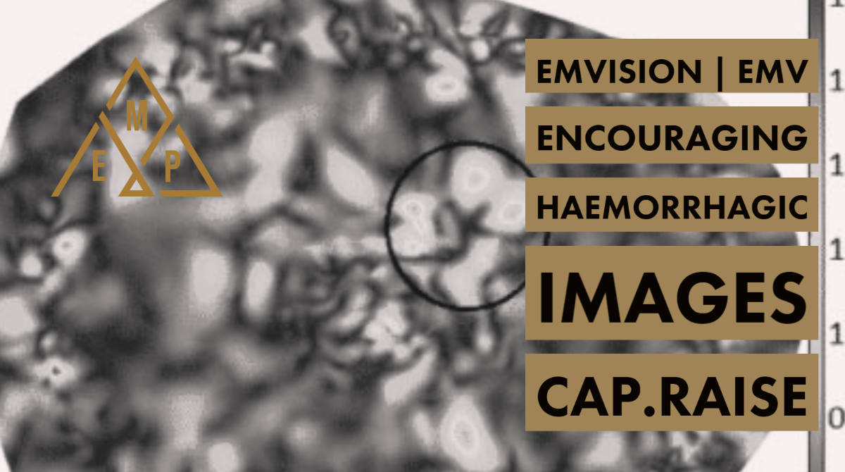 liquidityau's tweet photo. EMVision $EMV delivers encouraging haemorrhagic images from its clinical trial. Initiates Capital Raise #stroke #MRI #portable #medical #imaging #technology #austechnology #UQ #MACipo DETAIL LINK https://t.co/1fSCm2OvsY https://t.co/nue6NvxRVO
